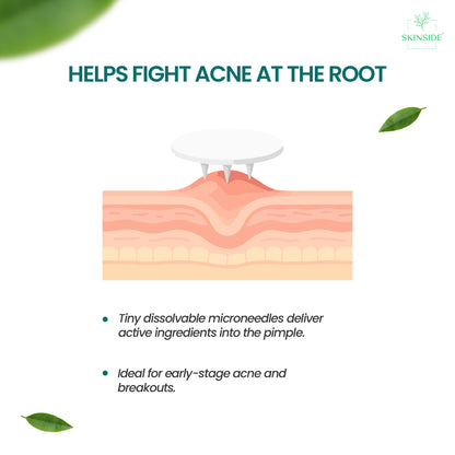 Microneedle Acne Patches