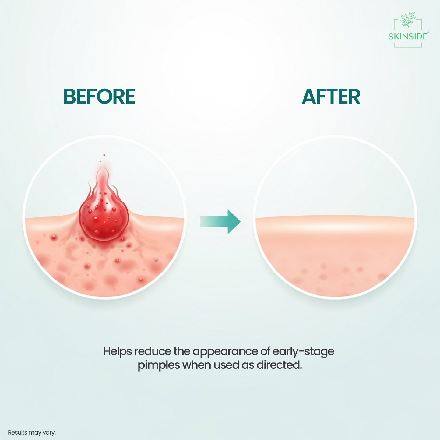 Microneedle Acne Patches