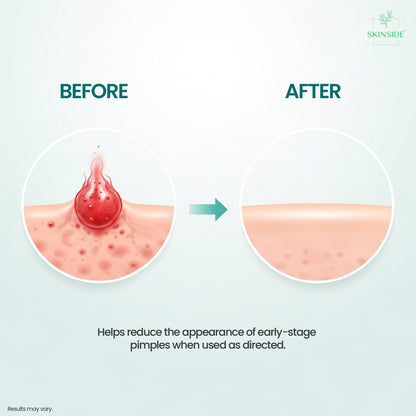 Microneedle Acne Patches