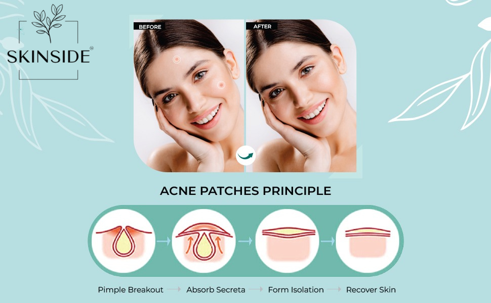Acne Pimple Patches - skinside