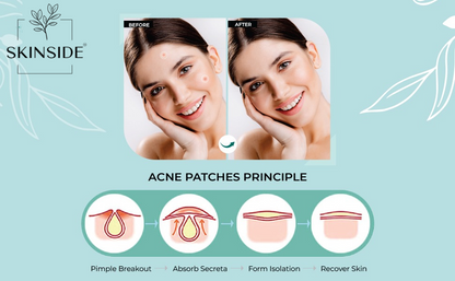 Acne Pimple Patches - skinside